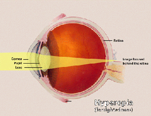 File:Hyperopia (1).gif