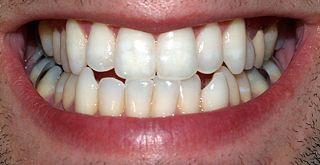 File:Dents-Denture-Bouche.jpg