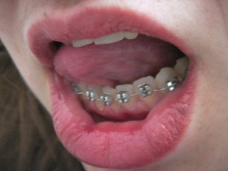 File:Braces Are Beautiful II-3952.jpg